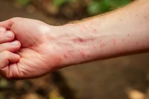 Health Issues and Triggered Allergies